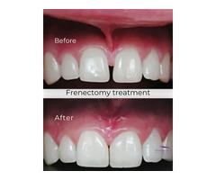 Looking for Frenectomy treatment?