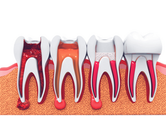 Affordable Invisalign Price in the UK