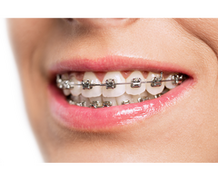 Affordable Invisalign Cost in London – Achieve a Perfect Smile Today