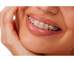 Invisible Braces in London – Achieve a Perfect Smile