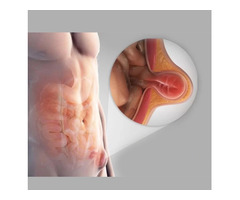 Hernia Surgery In Delhi NCR