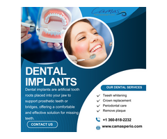 What are Dental Implants Placement ?