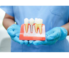 What are Dental Implants Placement ? - Image 2