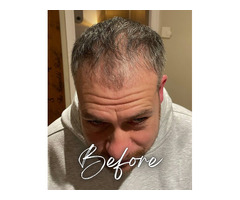 Hair Plantation in UK – Trusted Hair Transplant Clinic