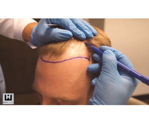 Best Hair Transplant Turkey - Affordable & Natural Results