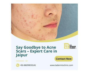 Say Goodbye to Acne Scars – Expert Care in Jaipur