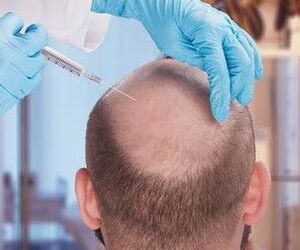 Want Hair Ltd - Trusted FUE Hair Transplant Clinic in Manchester - Image 2