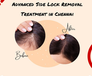 Advanced Side Lock Hair Removal Treatment in Chennai