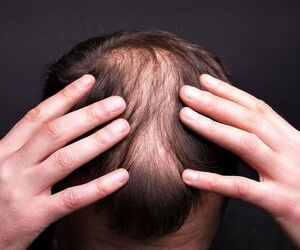 Say Goodbye to Hair Loss - Try Alopecia Treatment UK - Image 2