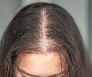 Say Goodbye to Hair Loss - Try Alopecia Treatment UK - Image 3