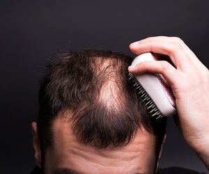 Say Goodbye to Hair Loss - Try Alopecia Treatment UK - Image 4