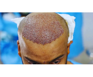 Hair transplant in Ahmedabad
