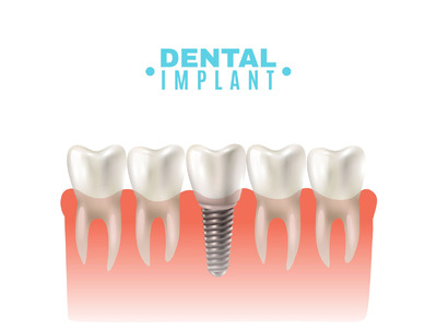 Are Dental Implants Right for You? Signs You May Be a Good Candidate