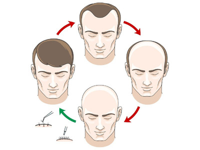 Stop Hair Loss Today - Book the Best FUE Hair Transplant in the UK!