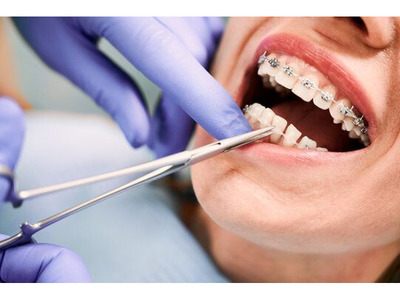 Best Orthodontist in Pune | Braces Treatment