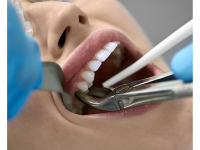 Ceramic dental implants los angeles