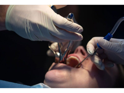 All on four implants