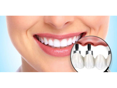 All on 4 dental implants in-house financing near me