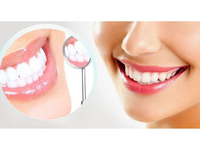 All on 4 dental implants