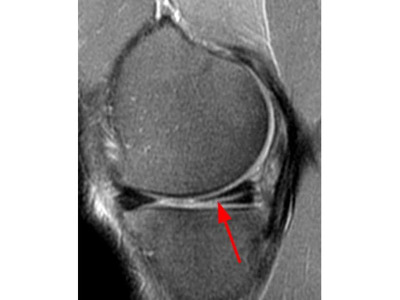 Where Can I Get an MRI of the Knee Joint Quickly?