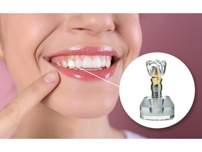 Overdenture Implants Dentistry services near Whittier