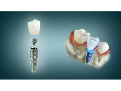 General Dentistry in Palo Alto, CA
