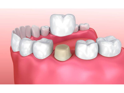 Best Dental Crowns in Pune | Expert Crown Treatment