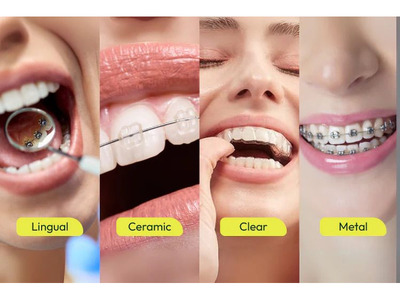 Affordable Braces for Teeth Treatment Cost Guide