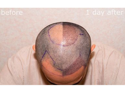 Don’t Lose More Hair – Book Your Free Hair Transplant Consultation Today! - Image 2