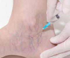 Sclerotherapy Treatment For Varicose And Spider veins In West New York | Advanced Medical Group